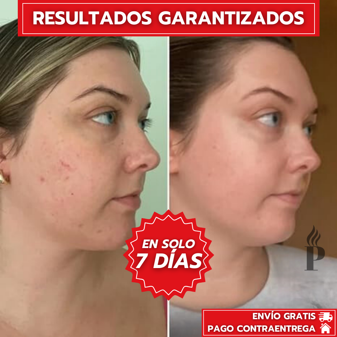 Serum10™: Serum Anti Acné Ultra Concentrado con Ácido Salicílico + 36 Parches Anti-Acné